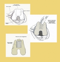 Lussazione della rotula: solcoplastica trocleare